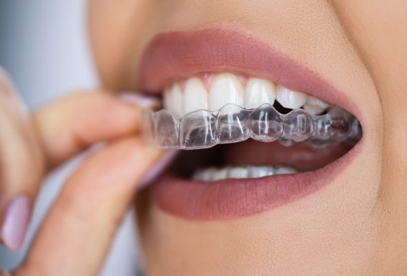 Clear Aligner Dental Night Guard For Teeth