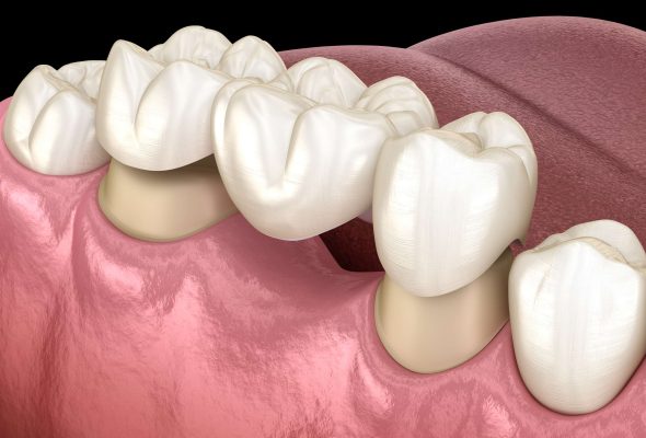 dental-bridge dental-bridge